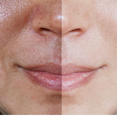 The Truth About Hyperpigmentation